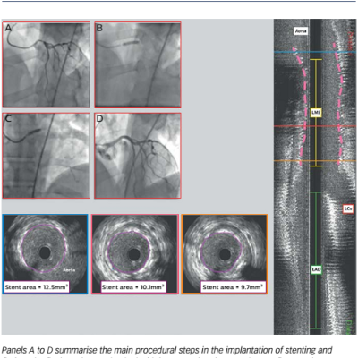 Figure 1 The Use of Intravascular Ultrasound in Ostial Left Main Disease