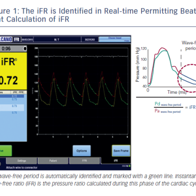 Figure 1 The iFR is Identified in Real-time Permitting Beat-bybeat Calculation of iFR