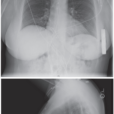 Figure-1-The-subcutaneous-implantable -cardioverter-defibrillator