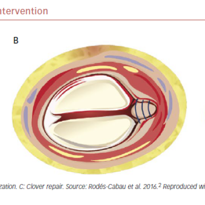Tricuspid Valve And Surgical Intervention
