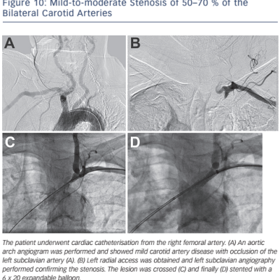 Figure 10 Mild-to-moderate Stenosis of 50–70  of the Bilateral Carotid Arteries