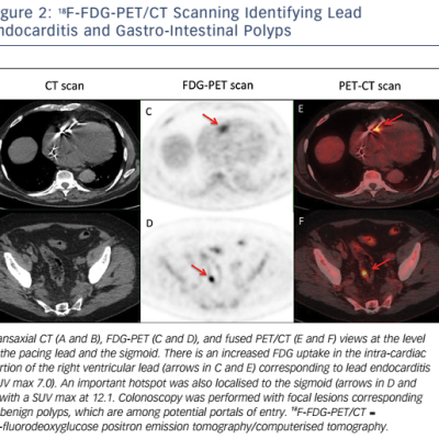 Figure 2 18F-FDG-PET/CT Scanning Identifying Lead Endocarditis and Gastro-Intestinal Polyps