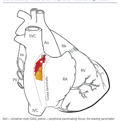 Figure 2 3D Computer Reconstruction of the Human Heart Sinoatrial Node from Histological and Immunohistochemical Data Demonstrating the Extent of the Sinoatrial Node and Peripheral Pacemaking Tissue