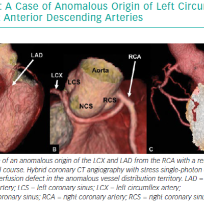 A Case Of Anomalous Origin Of Left Circumflex And Left Anterior Descending Arteries