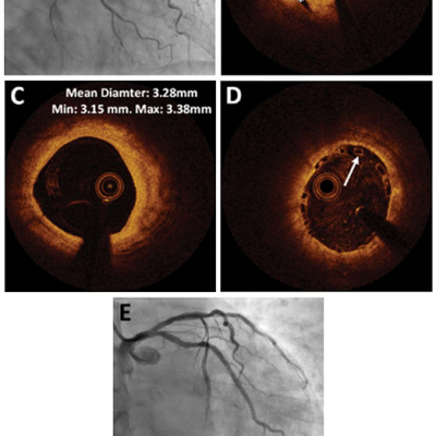 Figure 2 Angiography and OCT of BVS implanted in serial lesions in the left circumflex artery