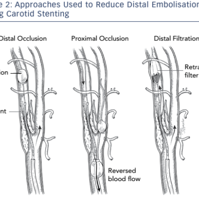 Figure 2 Approaches Used to Reduce Distal Embolisation During Carotid Stenting