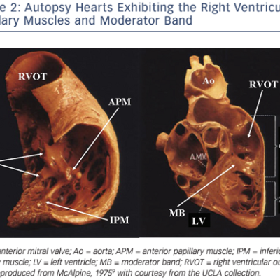 Figure-2-Autopsy-hearts-exhibiting-the-right-ventricular