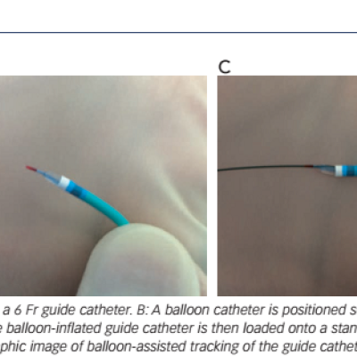 Figure 2 Balloon-Assisted Tracking