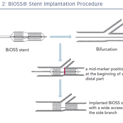 BiOSS® Stent Implantation Procedure