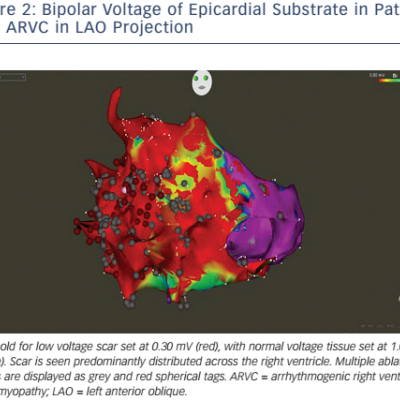 Bipolar Voltage of Epicardial Substrate in Patient with ARVC in LAO Projection