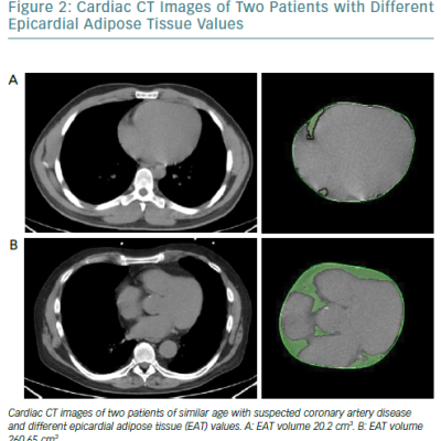 Cardiac CT Images Of Two Patients With Different Epicardial Adipose Tissue Values