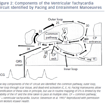 Components Of The Ventricular Tachycardia Circuit Identified By Pacing And Entrainment Manoeuvres