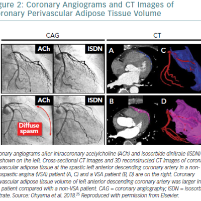 Coronary Angiograms And CT Images Of Coronary Perivascular Adipose Tissue Volume