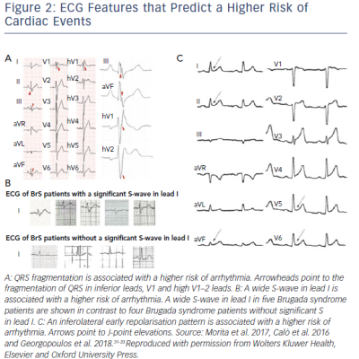 ECG Features That Predict A Higher Risk Of Cardiac Events