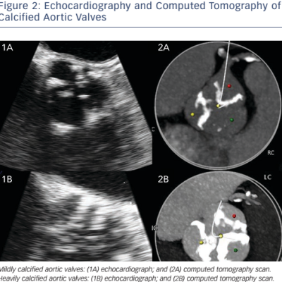 Figure 2 Echocardiography and Computed Tomography of Calcified Aortic Valves