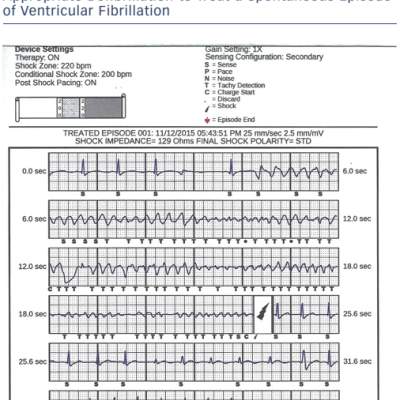 Figure-2-Electrocardiogram-recorded-by-a-subcutaneous-implantable 