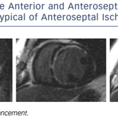 Figure 2 Extensive Anterior And Anteroseptal Subendocardial LGE Distribution Typical Of Anteroseptal Ischaemic Injury