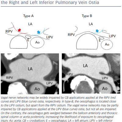 In Type-A The Oesophagus Is Located Between The Right And Left Inferior Pulmonary Vein Ostia