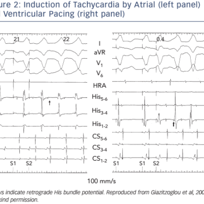 Figure 2 Induction of Tachycardia by Atrial left panel and Ventricular Pacing right panel