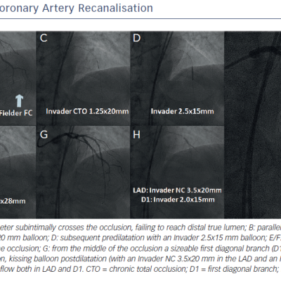 Left Anterior Descending Coronary Artery Recanalisation