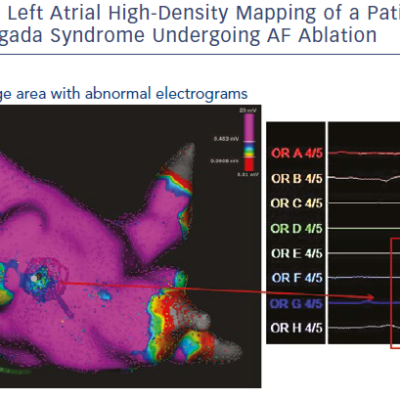 Left Atrial High-Density Mapping Of A Patient With Brugada Syndrome Undergoing AF Ablation