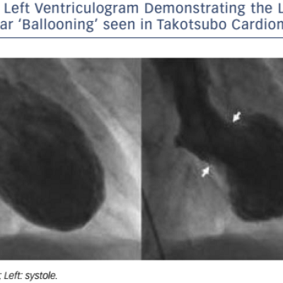 Figure 2 Left Ventriculogram Demonstrating the Left Ventricular ‘Ballooning’ seen in Takotsubo Cardiomyopathy