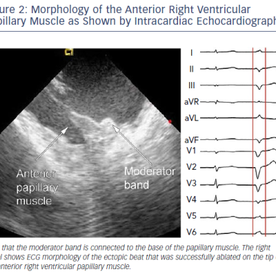 Morphology Of The Anterior Right Ventricular Papillary Muscle