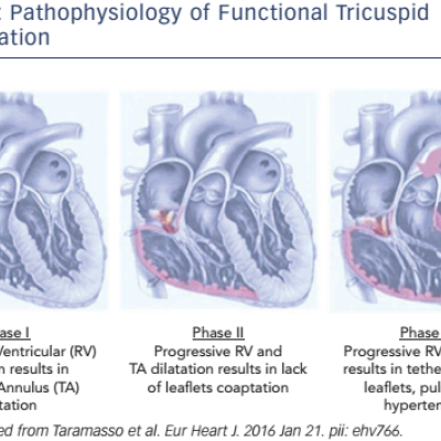 Figure 2 Pathophysiology of Functional Tricuspid Regurgitation