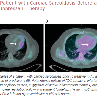 Patient With Cardiac Sarcoidosis Before And After Immunosuppressant Therapy