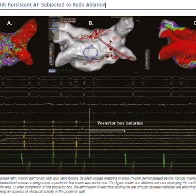 Patient with Persistent AF Subjected to Redo Ablation
