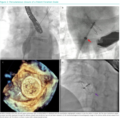 Percutaneous closure of a Patent Foramen Ovale