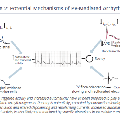 Potential Mechanisms of PV-Mediated Arrhythmia