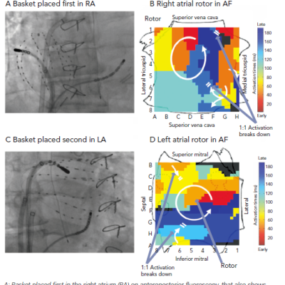 Process of Focal Impulse and Rotor Modulation-Guided Mapping and Ablation