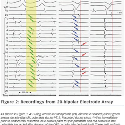 Figure 2 Recordings from 20-bipolar Electrode Array