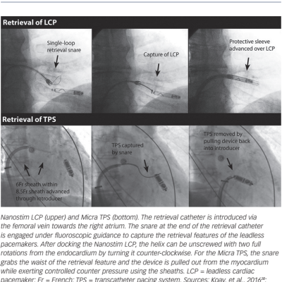 Retrieval of Leadless Pacemakers