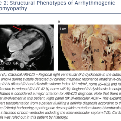 Figure 2 Structural Phenotypes of Arrhythmogenic Cardiomyopathy