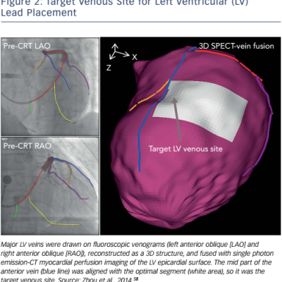 Figure 2 Target Venous Site for Left Ventricular LV Lead Placement