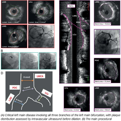 Figure 2 The Use of Intravascular Ultrasound in Bifurcation Left Main Disease