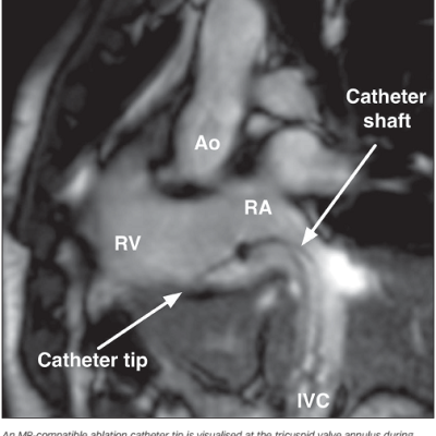 Figure 2 Passive Catheter Tracking