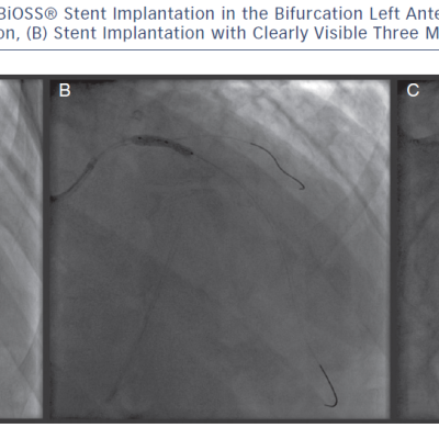 Angiographic Images From BiOSS® Stent Implantation