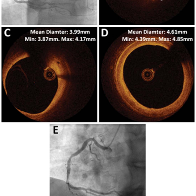 Figure 3 Angiography and OCT of a diseased right coronary artery too large for BVS implantation