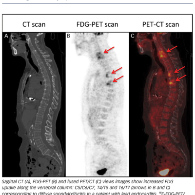 Figure 3 Diffuse Spondylodiscitis Revealed By 18F-FDG-PET/CT Scanning in an Asymptomatic Patient With Lead Endocarditis