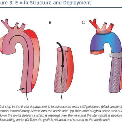 Figure 3 E-vita Structure and Deployment