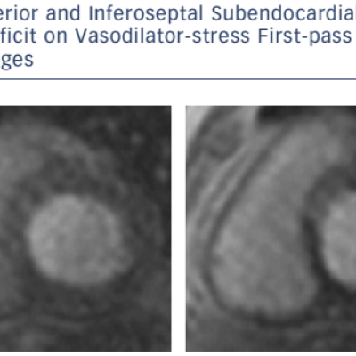 Figure 3 Inferior And Inferoseptal Subendocardial Inducible Perfusion Deficit On Vasodilator-Stress First-Pass Gadolinium Contrast Images