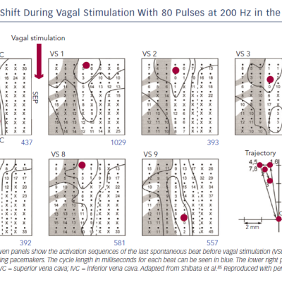Figure 3 Leading Pacemaker Shift During Vagal Stimulation With 80 Pulses at 200 Hz in the Isolated Rabbit Right Atrium