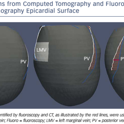 Figure 3 Left-ventricular Coronary Veins from Computed Tomography and Fluoroscopy Venograms Overlaid on the Single Photon Emission Computed Tomography Epicardial Surface