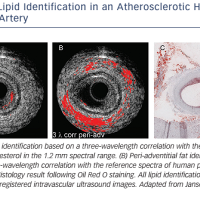 Lipid Identification in an Atherosclerotic Human Coronary Artery