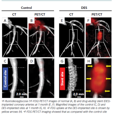 Perivascular Adipose Tissue Inflammation Evaluated By PET/CT