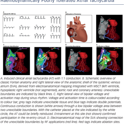 Figure 3 Procedural Workflow For Atrial Tachycardia Ablation In A Classic Fontan Patient With A Haemodynamically Poorly Tolerated Atrial Tachycardia