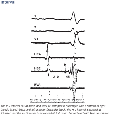 Figure 3 Prolonged P-R Interval with a Normal H-V Interval
